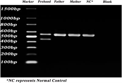 Case Report: A Synonymous Mutation in NF1 Located at the Non-canonical Splicing Site Leading to Exon 45 Skipping